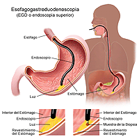 Ilustración de un procedimiento de esofagogastroduodenoscopia